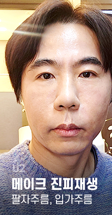 팔자주름 Real Before After! #shorts