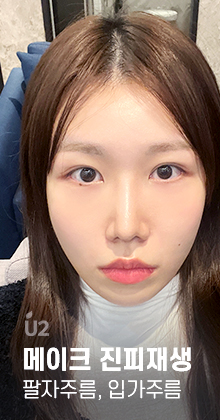 팔자주름 Real Before After! #shorts