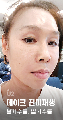 팔자주름 Real Before After! #shorts