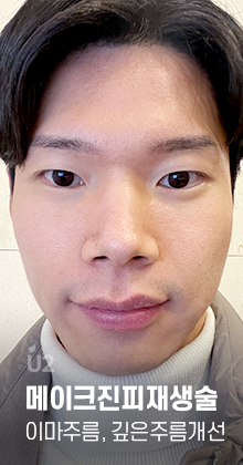 팔자주름 Real Before After! #shorts