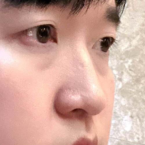 수술전