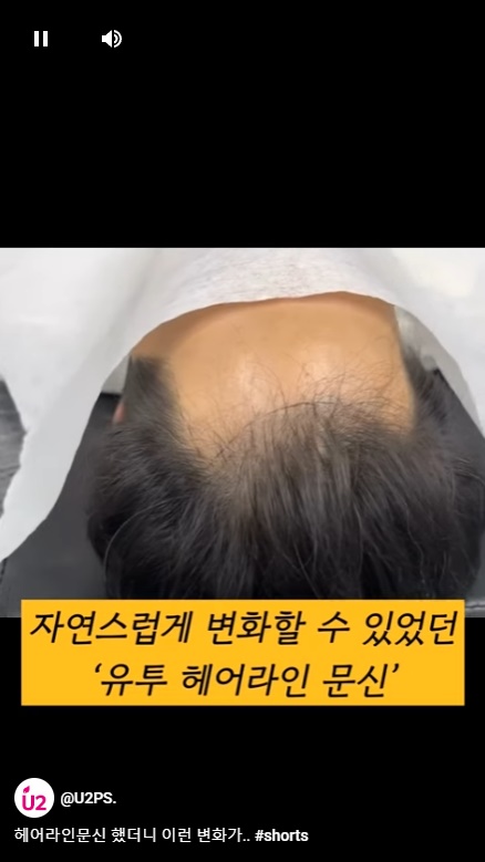 두피,헤어라인 문신